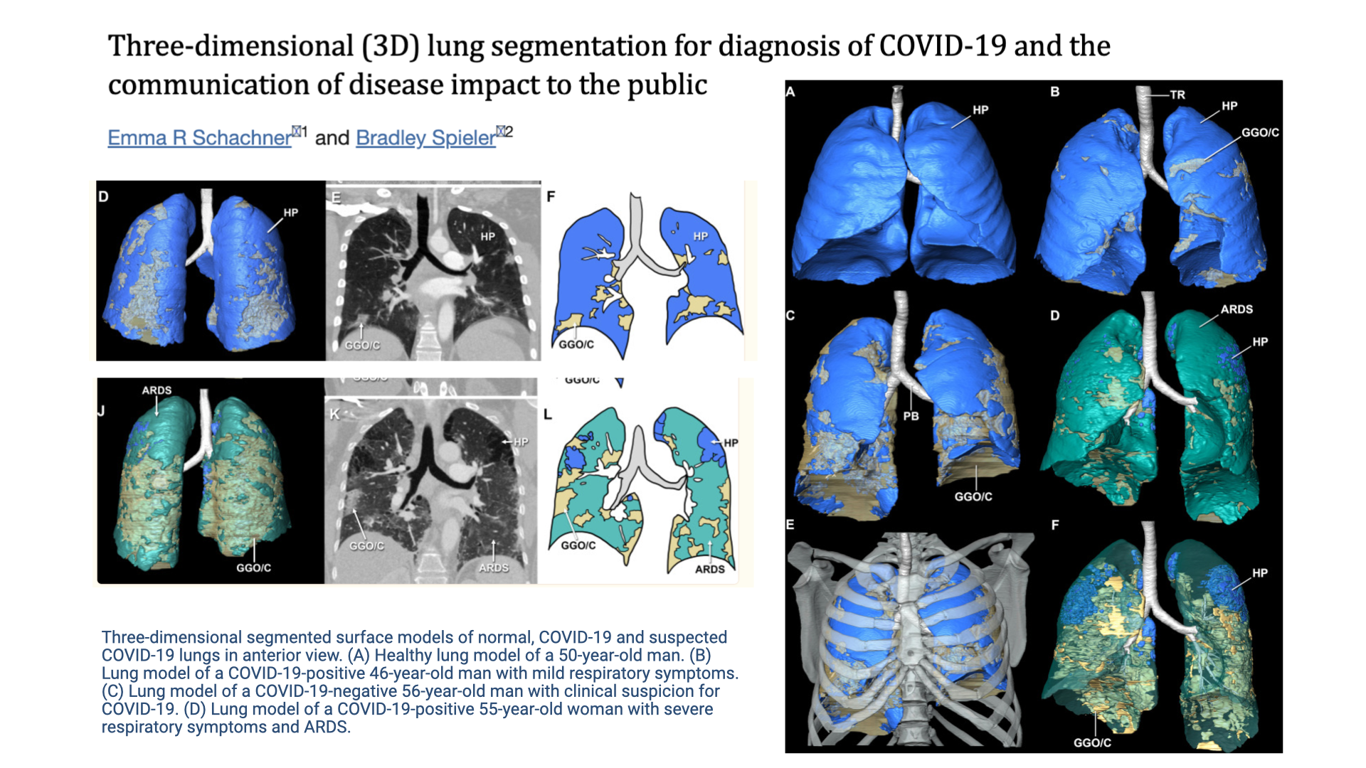 Slide titled "Three-dimensional (3D) lung segmentation for diagnosis of COVID-19 and the communication of disease impact to the public," showing a research paper by Schachner and Spieler. Multiple panels display 3D segmented lung models from CT scans: (A) healthy lung in blue, (B–D) COVID-19 affected lungs showing areas of ground-glass opacity and ARDS in contrasting colors. The right side shows four 3D-rendered lung models in anterior view comparing healthy tissue (blue) against diseased regions (teal/orange/yellow).