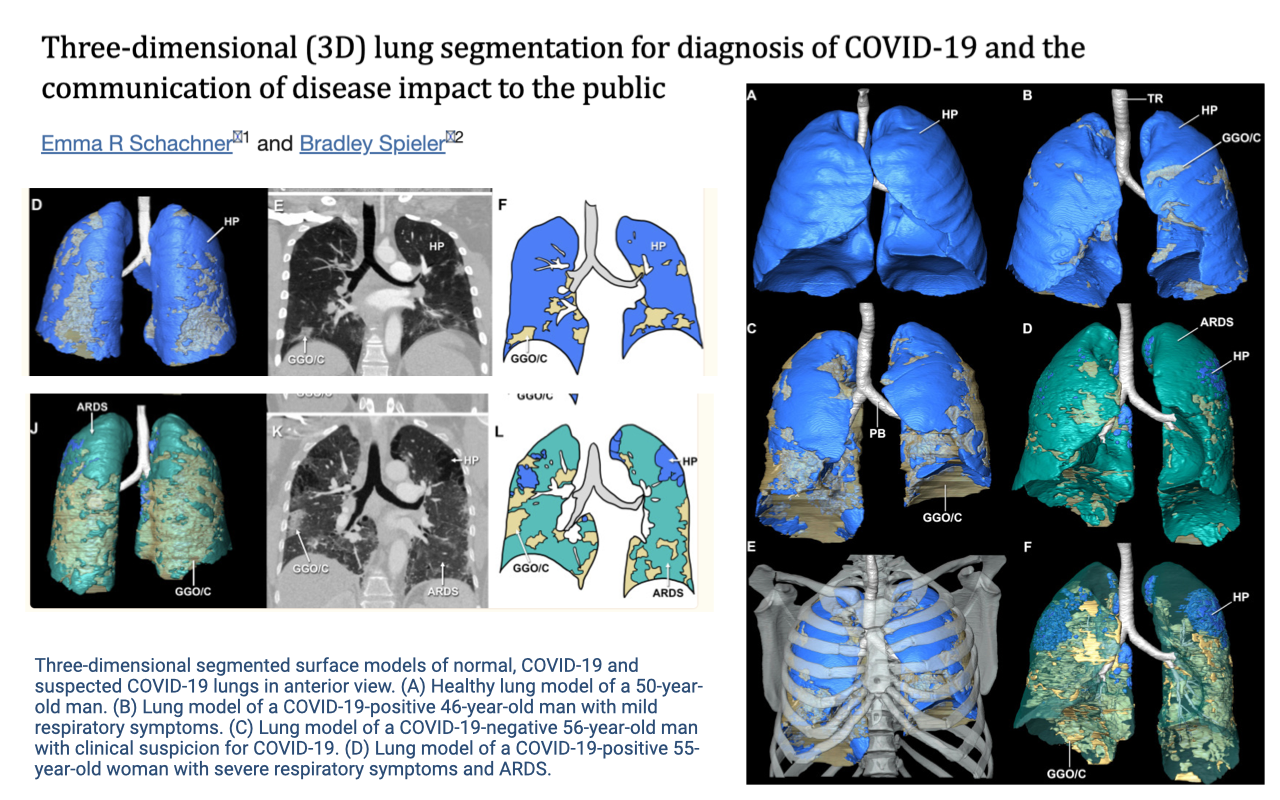Slide titled "Three-dimensional (3D) lung segmentation for diagnosis of COVID-19 and the communication of disease impact to the public," showing a research paper by Schachner and Spieler. Multiple panels display 3D segmented lung models from CT scans: (A) healthy lung in blue, (B–D) COVID-19 affected lungs showing areas of ground-glass opacity and ARDS in contrasting colors. The right side shows four 3D-rendered lung models in anterior view comparing healthy tissue (blue) against diseased regions (teal/orange/yellow).